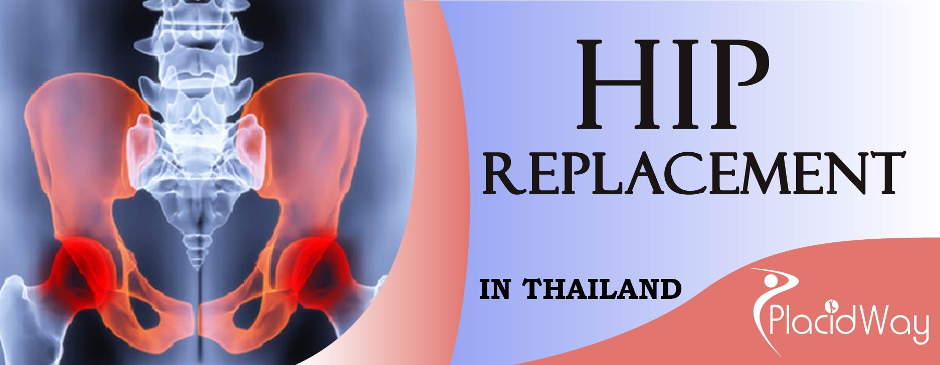 Hip Replacement Surgery Package in Thailand Affordable Prices